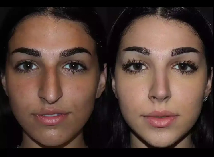 Best Rhinoplasty Surgeon in Dubai: Your Path to Facial Harmony and Confidence