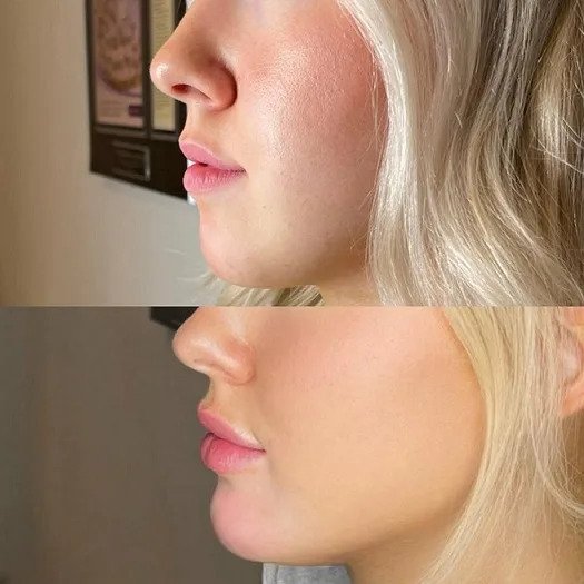 Chin Fillers treatment  by the Best Plastic Surgeon in dubai for Perfect Results