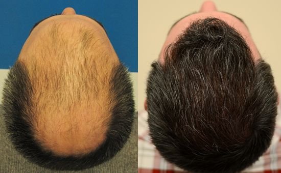 Hair Transplant Before and After: What to Expect at Dailyscope