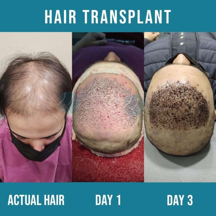 The Best Hair Transplant in Pakistan: A Comprehensive Guide to Institute Cosmetique's Expertise