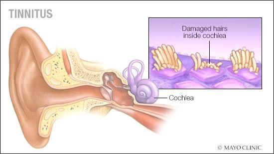 Tinnitus Cure in Pakistan and ASSR Hearing Test Price