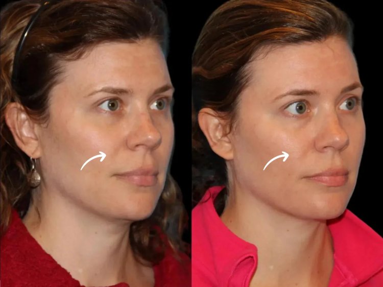 Best Aesthetic Clinics in dubai Offer Customized Sculptra Plans for Every Patient