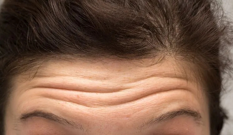 Erase Forehead Lines in No Time: Proven Solutions for Smoother Skin