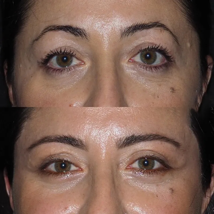 Consulting the Best Eye bag removal Surgeon in dubai: What You Should Know