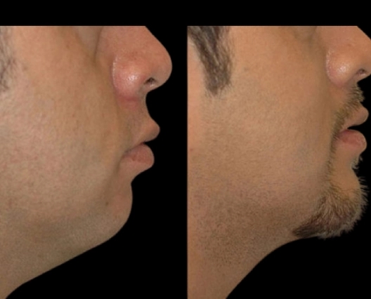 Why You Should Only Trust the Best Double chin removal Surgeon in dubai