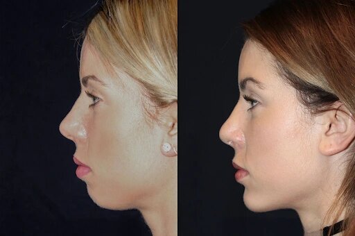 Chin Fillers Treatments in Dubai: Say Goodbye to a Weak Chin