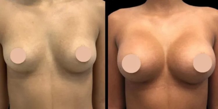 Breast Augmentation in Dubai: Preparing for Your Consultation and What to Ask the Surgeon