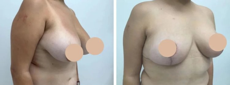 Breast Reduction in Dubai: Comparing Surgical Approaches for Best Results