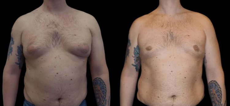 Gynecomastia in Dubai: Understanding Bilateral Gynecomastia and Its Treatments